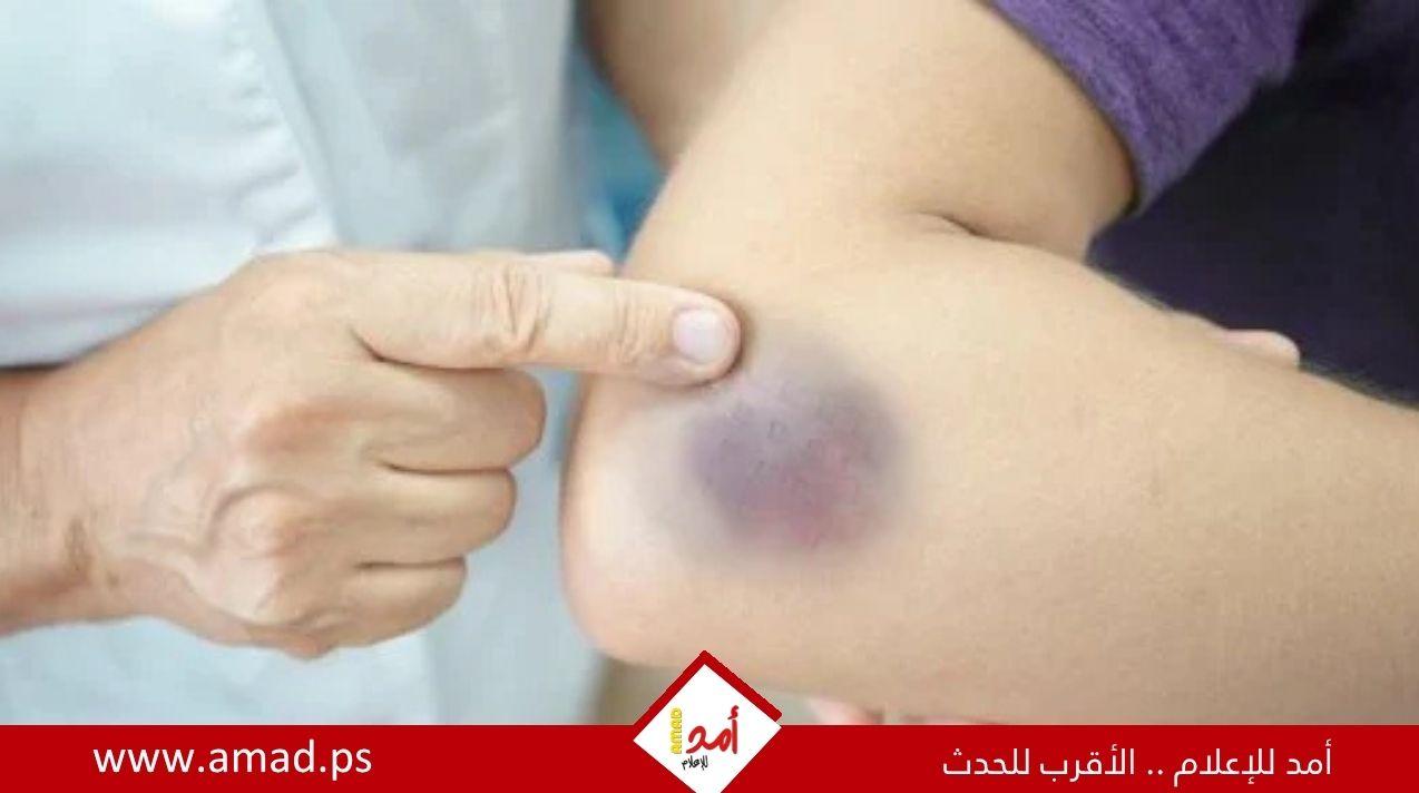 ظهور الكدمات على الجسم دون سبب واضح - تفاصيل