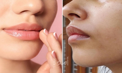 4 علاجات منزلية لإزالة الجلد الداكن حول الفم